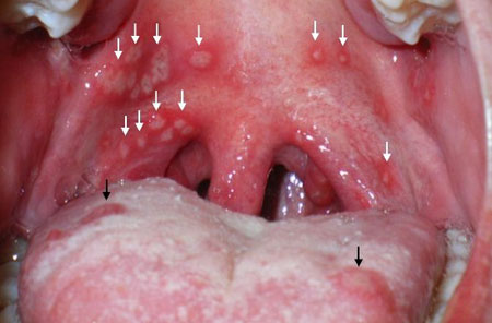 Герпесная ангина — фото, симптомы и лечение у детей, препараты 