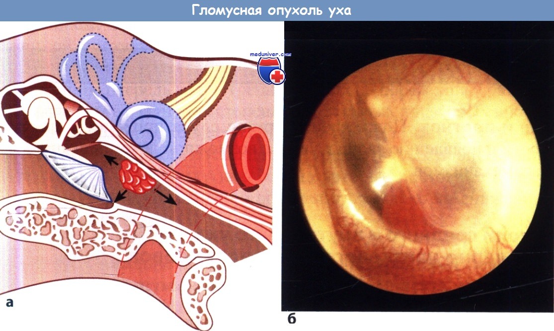 Гломусная опухоль среднего уха 