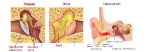 Гнойный отит: причины, симптомы и лечение 