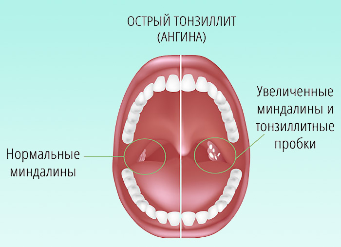 Гнойный тонзиллит: лечение, симптомы, последствия 