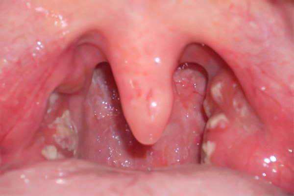 Грибок горла: причины, симптомы и лечение у взрослых и детей 