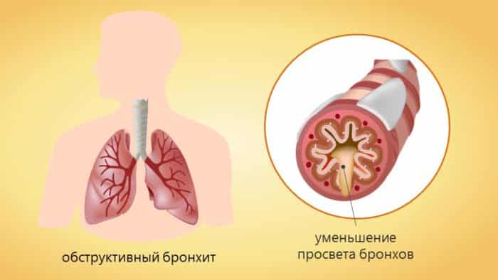 Какие ингаляции проводить при бронхите 