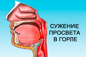 Как лечить отекшее горло 