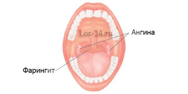 Как отличить ангину от фарингита — хаpaктерные особенности и сходства болезней 