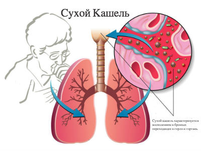 Как подобрать надежный препарат при сухом кашле для взрослого 