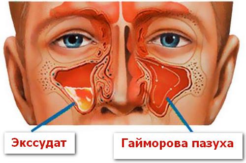 Как распознать и вылечить экссудативный гайморит? 