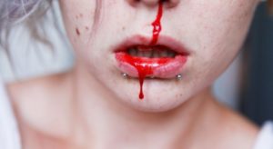 Как самостоятельно остановить кровь из носа 