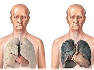 Как восстановить легкие от никотина после курения 