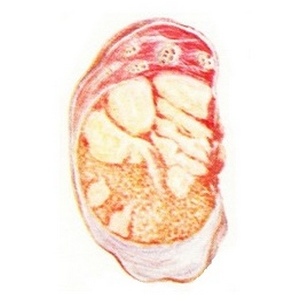 Как возникает и проявляется туберкулез яичка? 