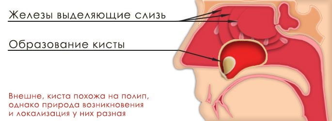 Кисты околоносовых пазух 