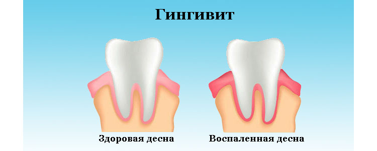 Лечение хронического ларингита 