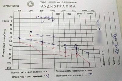 Лечение сенсоневральной тугоухости различной степени 