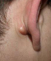 Лечение воспаленного лимфоузла за ухом 