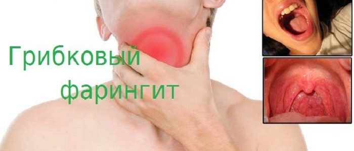 Методы эффективного лечения грибкового фарингита и устранения симптомов 