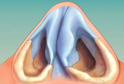 Методы лечения хронической заложенности носа 