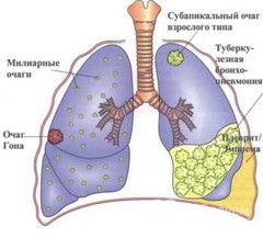 Милиарный туберкулез 