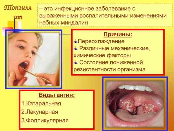 Можно ли вылечить ангину без антибиотиков 