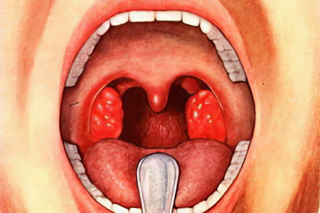 Опасность стрептококкового фарингита 