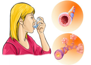 Осложнения бронхиальной астмы и их последствия 
