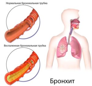 Основные отличия бронхита и пневмонии 