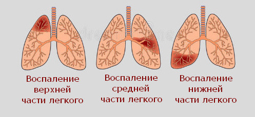 Особенности левосторонней нижнедолевой пневмонии: что это такое 