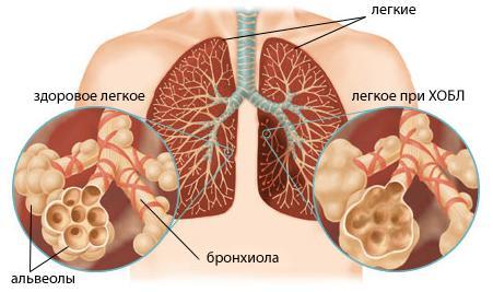 Острый обструктивный бронхит 