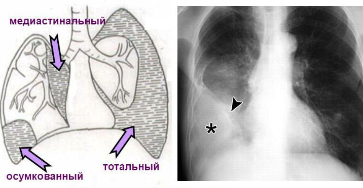 Осумкованный плеврит 