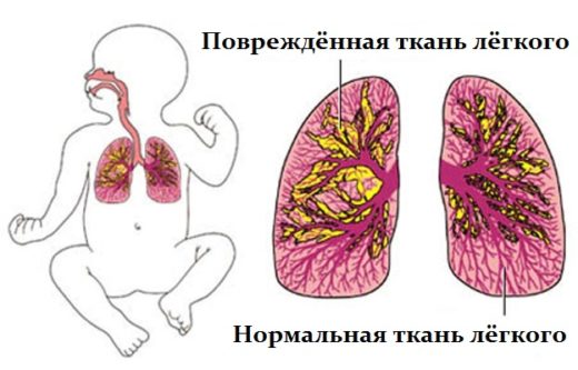 Пневмония у новорождённых — большая угроза для самых маленьких 