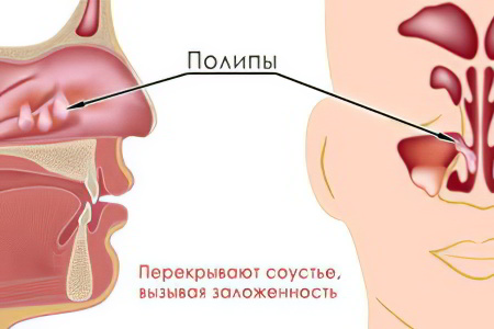 Полипозный и кистозный синусит: лечение, причины и симптомы 