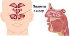 Полипозный риносинусит 