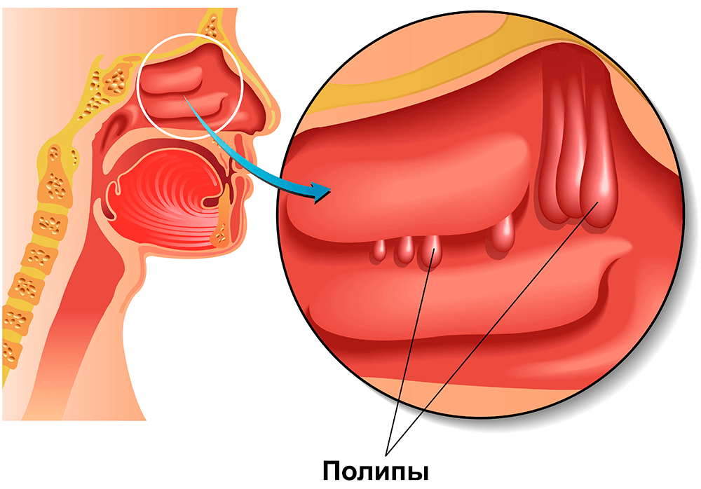 Полипы носа 