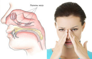 Полипы в носу: как правильно лечить образование? 
