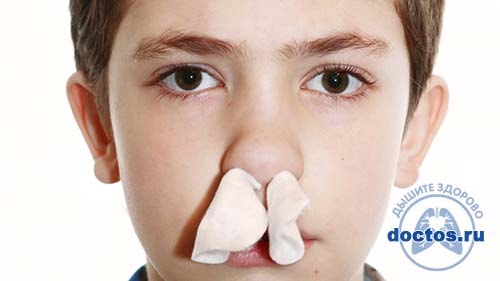 Причины и лечение носового кровотечения у подростков 