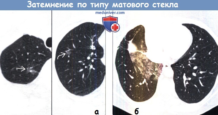 Причины и проявления симптома матового стекла в легких 