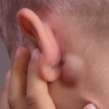 Причины появления шишки за ухом. Как избавиться от шишки за ухом традиционными и нетрадиционными методами лечения 