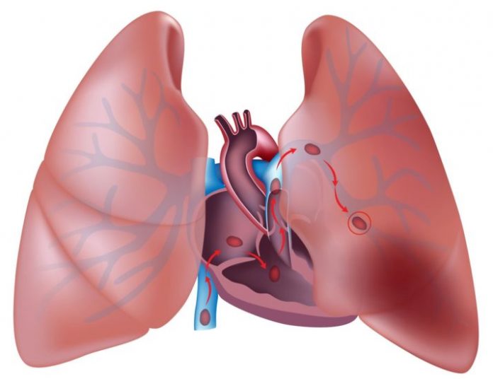 Причины, симптомы, способы лечения лёгочной эмболии 