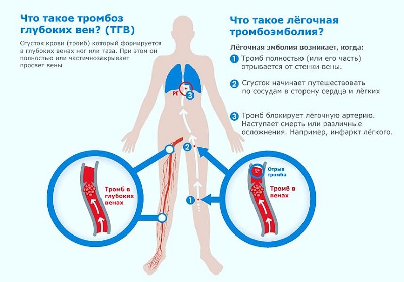 Процент выживания людей с тромбом в легких и его лечение 