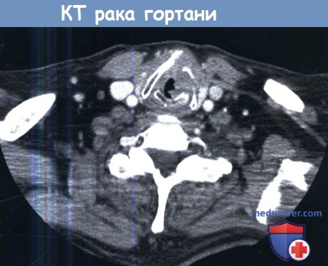 Самостоятельная и медицинская диагностика paка горла 