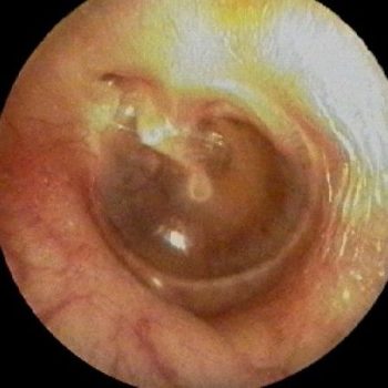Серозный отит: описание, симптомы и методы лечения 