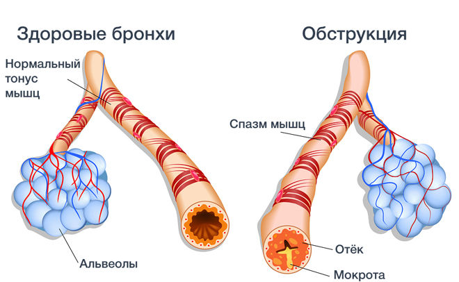 Симптомы, диагностика и лечение хронического обструктивного бронхита 