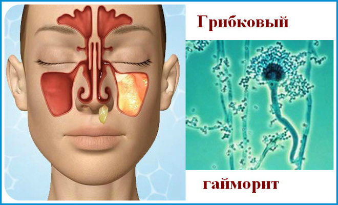 Симптомы и лечение грибкового гайморита у взрослых 