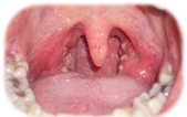 Симптомы и причины герпеса в горле у взрослых и детей. Как лечить? 