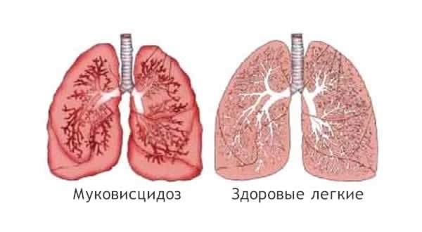 Симптомы муковисцидоза у детей и принципы лечения 