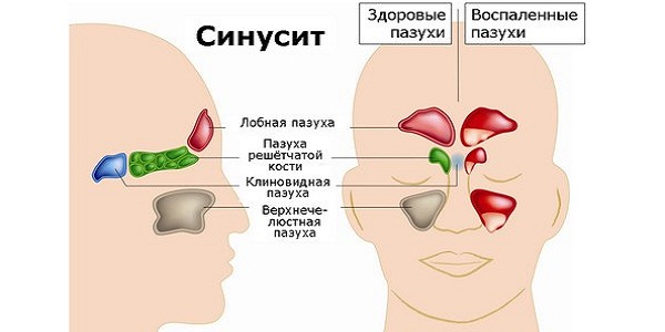 Симптомы синусита у взрослых и его лечение 