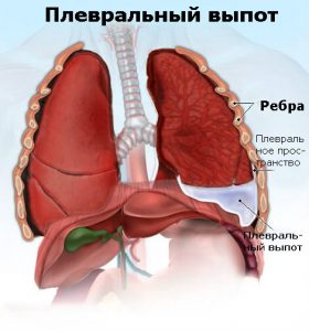 Синдром плеврального выпота: причины, симптомы, лечение 