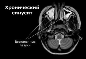 Синусит — что это такое, виды, причины, признаки, симптомы и лечение синусита у взрослых 