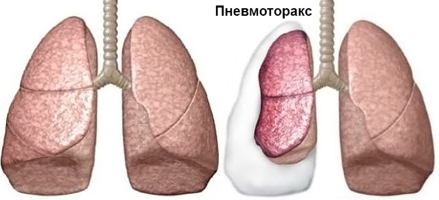 Спонтанный пневмотоpaкс: причины симптомы и лечение 