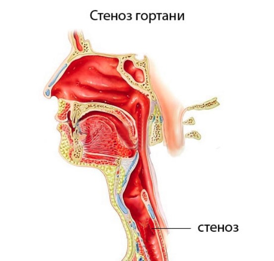 Стеноз гортани у детей 