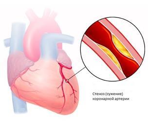 Стеноз клапанов и сосудов сердца: что это такое, причины возникновения патологии, методы борьбы с ней 