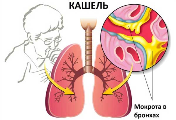 Цвет мокроты при пневмонии 